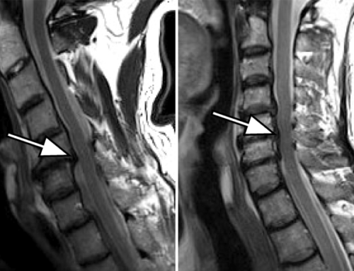 Quantification of spinal cord compression using T1 mapping in patients with cervical spinal canal stenosis – Preliminary experience.