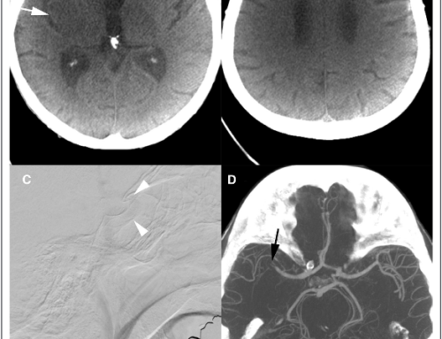 One-Stop Management of Acute Stroke Patients: Minimizing Door-to-Reperfusion Times.