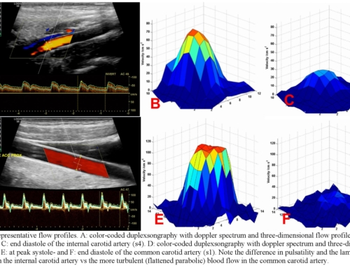 Carotid artery flow as determined by real-time phase-contrast flow MRI and neurovascular ultrasound: A comparative study of healthy subjects.