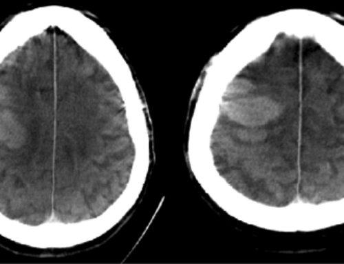 One-Stop Management of 230 Consecutive Acute Stroke Patients: Report of Procedural Times and Clinical Outcome.